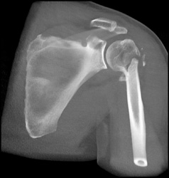 Humerus Fracture - CTisus CT Scan