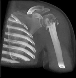 Humerus Fracture - CTisus CT Scan