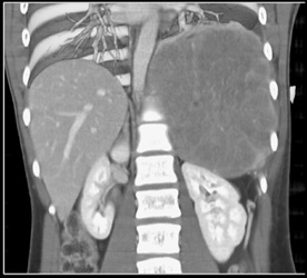 Ewing Sarcoma - CTisus CT Scan