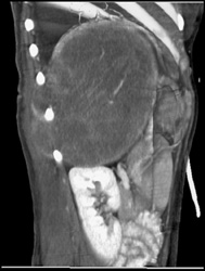 Ewing Sarcoma - CTisus CT Scan