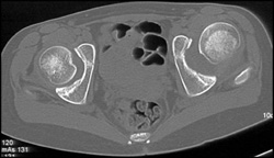 Chd - CTisus CT Scan