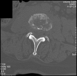 Osteomyelitis - CTisus CT Scan