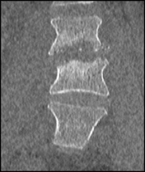 Osteomyelitis - CTisus CT Scan