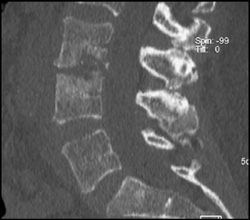 Osteomyelitis - CTisus CT Scan