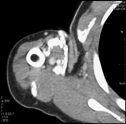 Heterotopic Ossifications - CTisus CT Scan