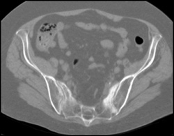 Stress Fracture Sacrum - CTisus CT Scan