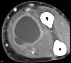 Abscess - CTisus CT Scan