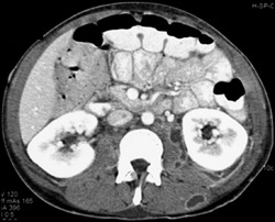 Intramuscular Abscess - CTisus CT Scan