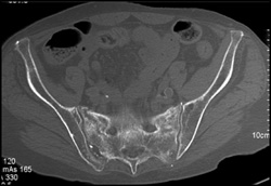 Stress Fracture Sacrum - CTisus CT Scan