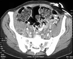 Psoas Abscess - CTisus CT Scan