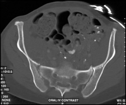 Right Sacroiliitis - CTisus CT Scan