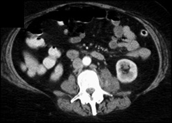 Osteomyelitis - CTisus CT Scan