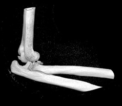 Radius and Ulnar Fracture - CTisus CT Scan