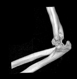 Dislocated Elbow - CTisus CT Scan