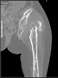 Osteogenesis Imperfecta With Heterotopic Ossification - CTisus CT Scan