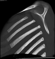 Normal Ribs - CTisus CT Scan