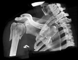 Humerus and Scapular Fracture - CTisus CT Scan