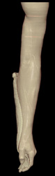 Normal Arm in 3D - CTisus CT Scan