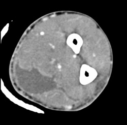 Abscess - CTisus CT Scan