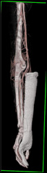 CTA Arm - CTisus CT Scan