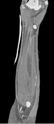 Abscess - CTisus CT Scan