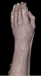 3D of the Wrist - CTisus CT Scan