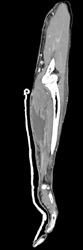 Arm Abscess - CTisus CT Scan