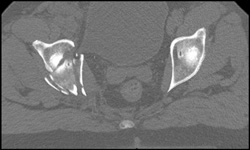 Acetabular and Iliac Wing Fracture - CTisus CT Scan