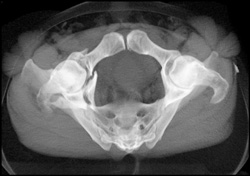 3D of Fractures - CTisus CT Scan