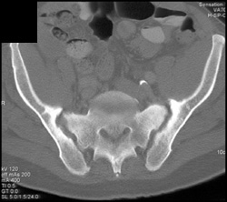 Erosion of SI Joints - CTisus CT Scan