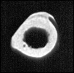 Old Stress Fracture - CTisus CT Scan