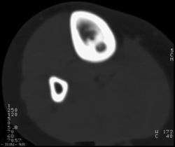 Osteoid Osteoma - CTisus CT Scan