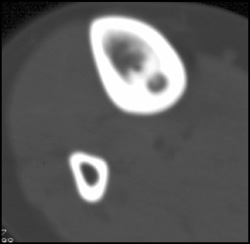 Osteoid Osteoma - CTisus CT Scan