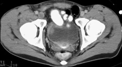 Psoas Abscess - CTisus CT Scan