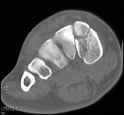 Fracture - CTisus CT Scan