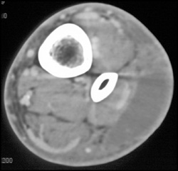 Cellulitis - CTisus CT Scan