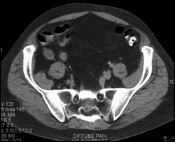 Mild Sacroiliitis - CTisus CT Scan