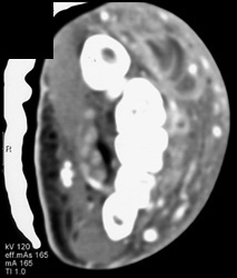 Abscess - CTisus CT Scan