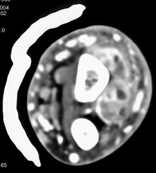 Abscess - CTisus CT Scan