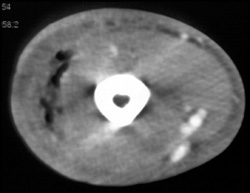 Necrotizing Fasciitis - CTisus CT Scan