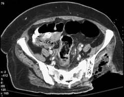 Abscess - CTisus CT Scan