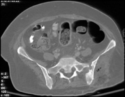 Infection of Left SI Joint With Abscess - CTisus CT Scan