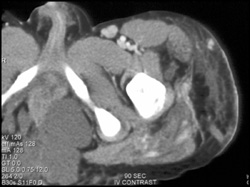 Klippel-Trenaunay-Weber (KTW) Syndrome - CTisus CT Scan