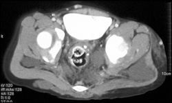 Lymphangioma/hemangioma - CTisus CT Scan