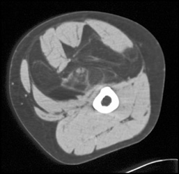 Liposarcoma - CTisus CT Scan