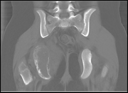 Ewing Sarcoma - CTisus CT Scan