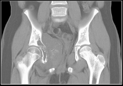 Ewing Sarcoma - CTisus CT Scan