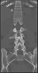 Metastases - CTisus CT Scan