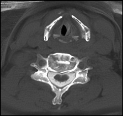 Fused Vertebral Bodies - CTisus CT Scan