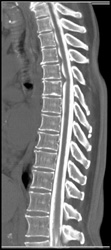 Ct Myelogram With Disc Disease - CTisus CT Scan